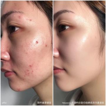 因為史湘云的臉上犯了杏斑癬,于是有了治療藥物薔薇硝出場,但是被茉莉粉